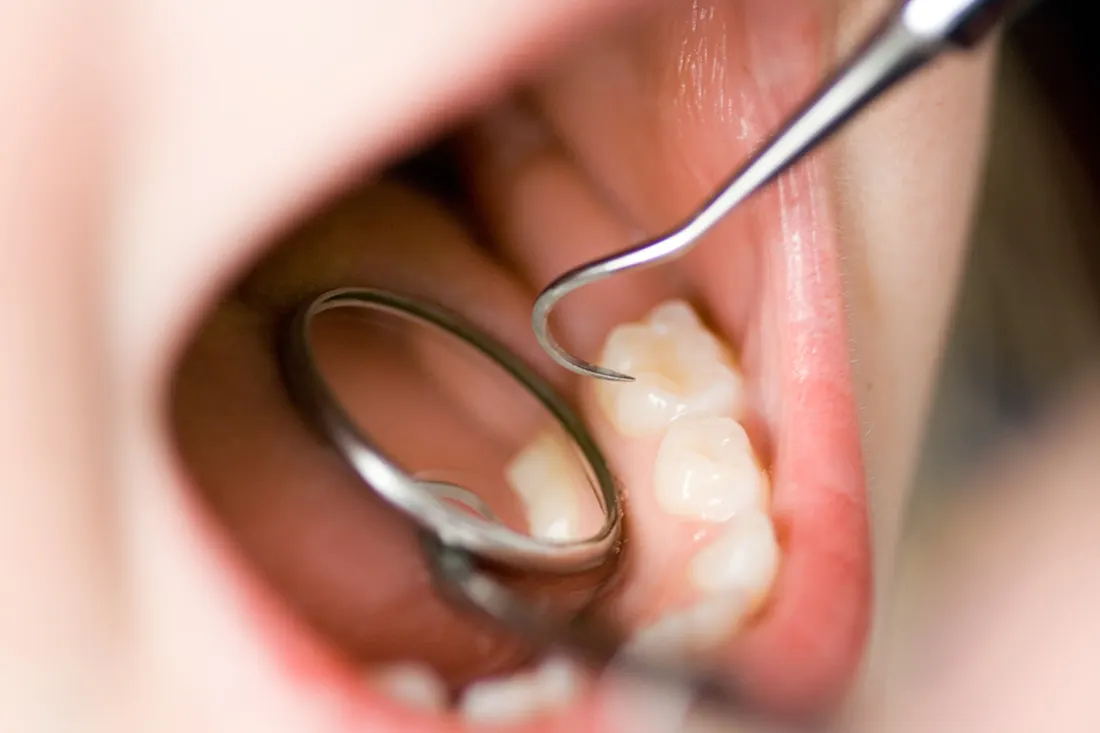 Pediatric Dental Fillings in Newton | Bee Happy Pediatric Dentistry