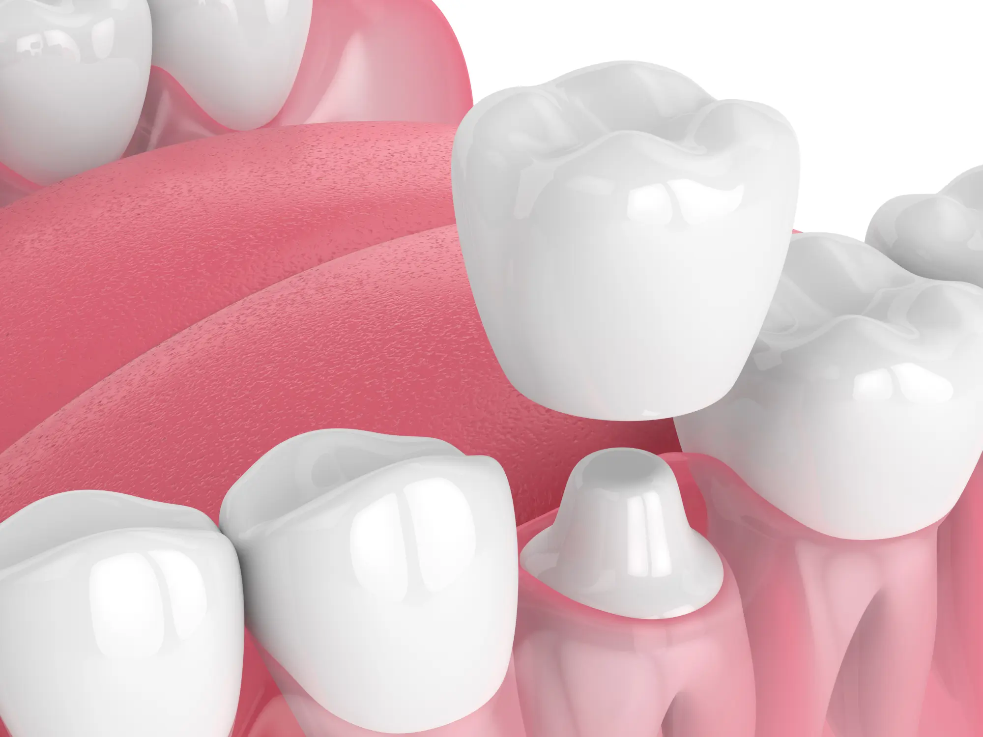Pediatric Dental Crowns in Newton | Bee Happy Pediatric Dentistry