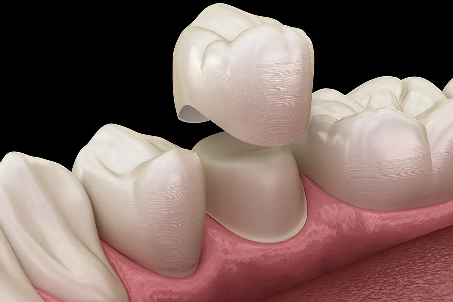 Pediatric Dental Crowns in Newton | Bee Happy Pediatric Dentistry