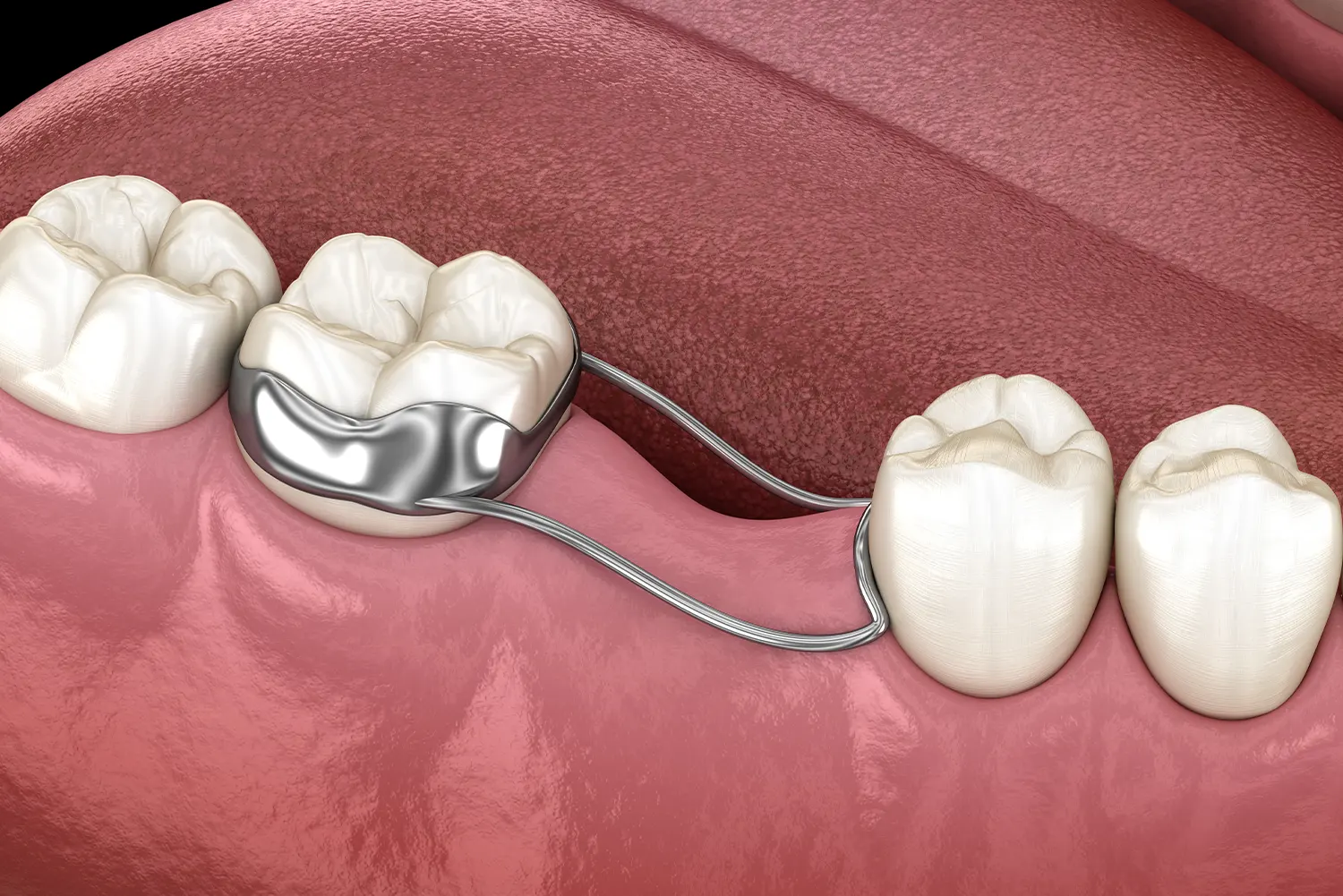 Space Maintainers in Newton | Bee Happy Pediatric Dentistry